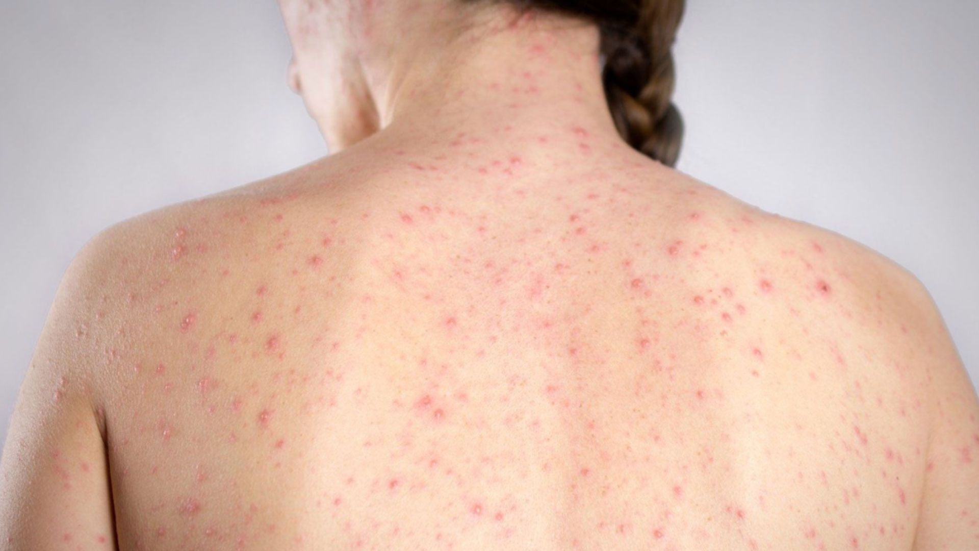 México podría perder su estatus de “zona libre de sarampión”; OPS alerta por brote